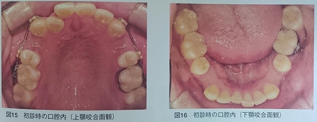 編集長のブログ69 4番4本抜歯矯正が生体に与えた影響とは 株式会社 第一歯科出版